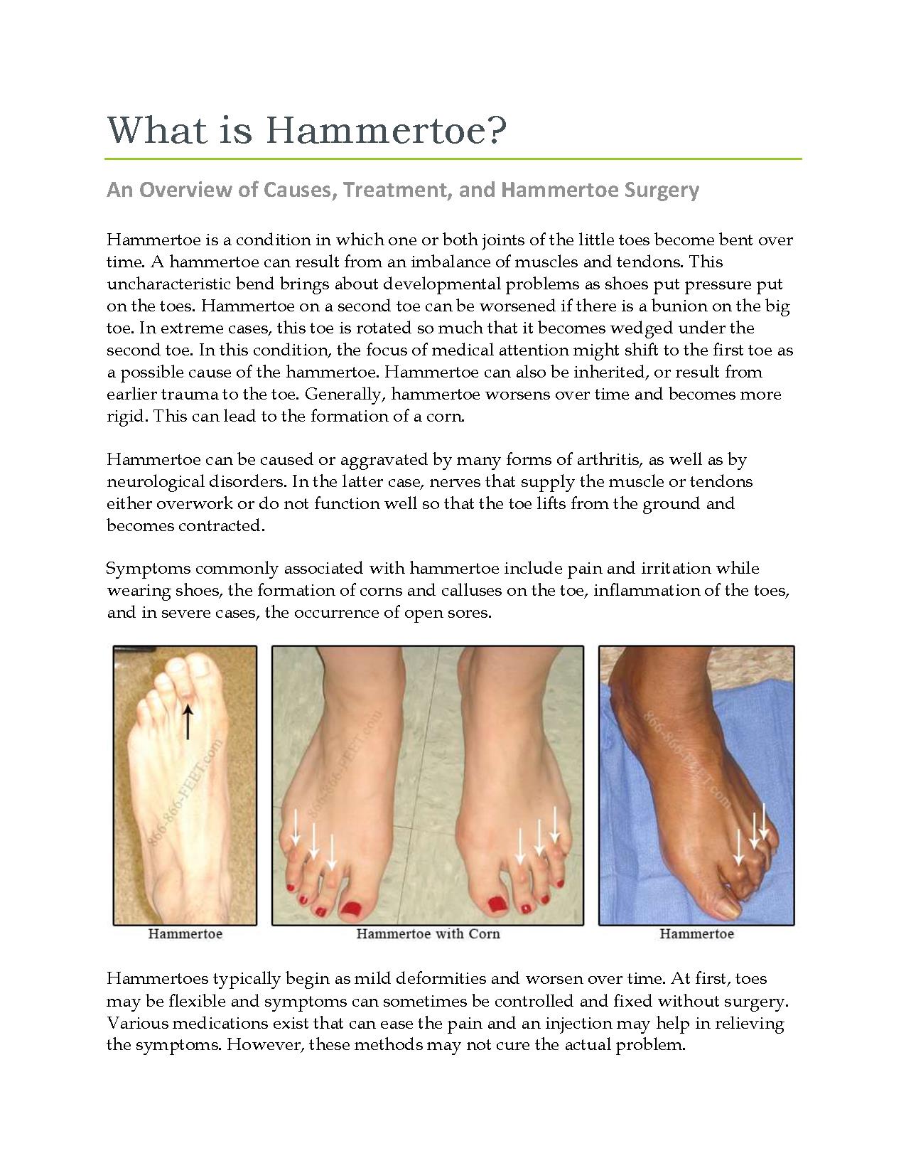 Overview of Causes, Treatment, and Hammertoe Surgery PowerPoint